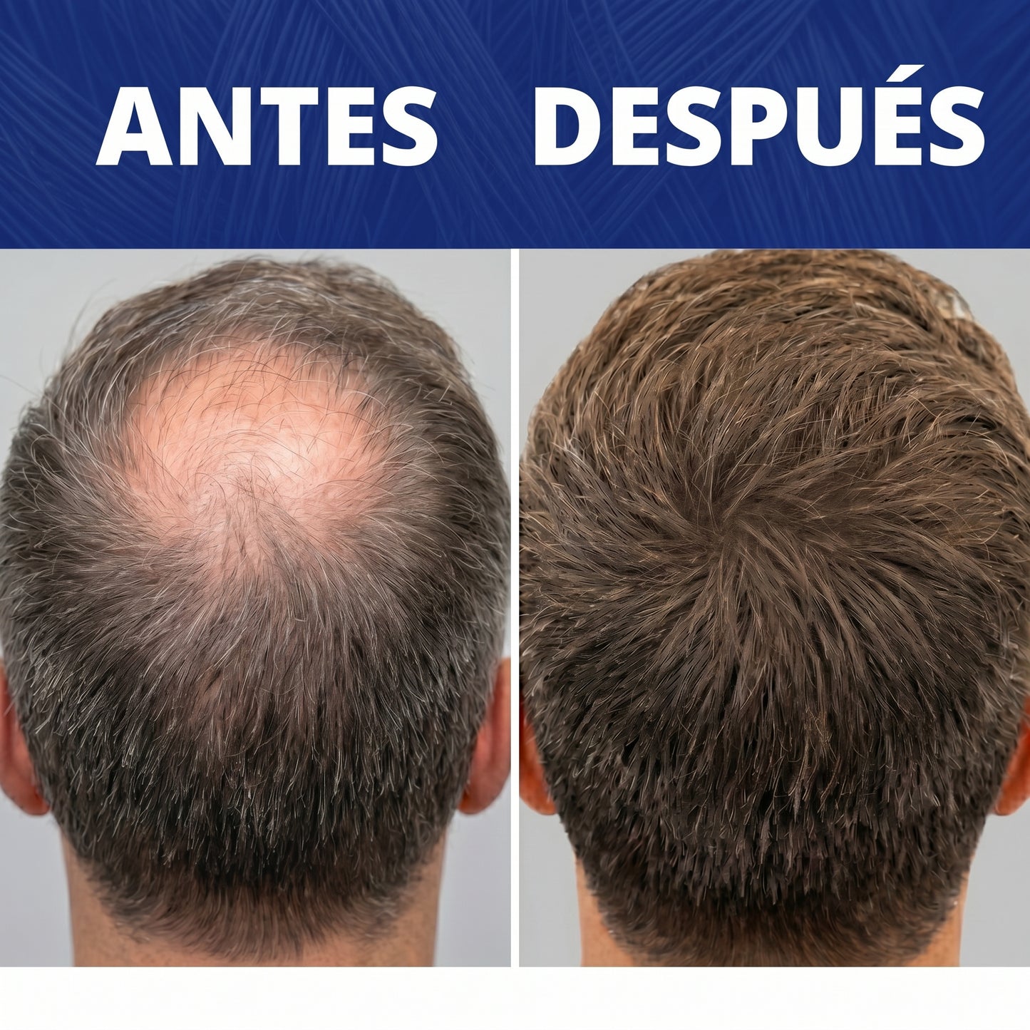 Follicle™ - Densificador capilar